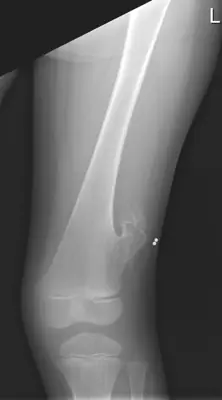 Radiograph from the case bank: Osteochondroma (exostosis)