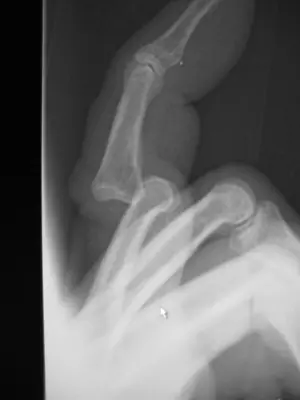Radiograph from the case bank: Finger (interphalangeal) dislocation