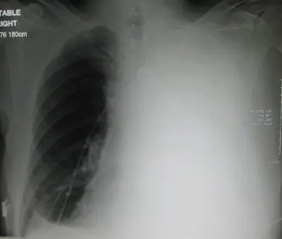 Radiograph from the case bank: Pleural effusion