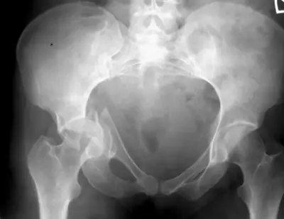Radiograph from the case bank: Acetabular fracture