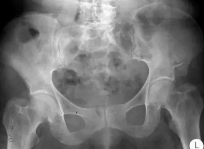 Radiograph from the case bank: Hip (proximal femoral) fracture