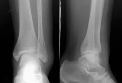 Radiograph from the case bank: Ankle fracture (lateral malleolus)