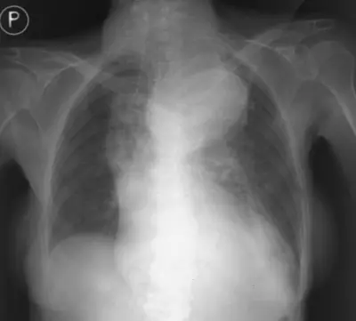 Radiograph from the case bank: Thoracic aortic aneurysm
