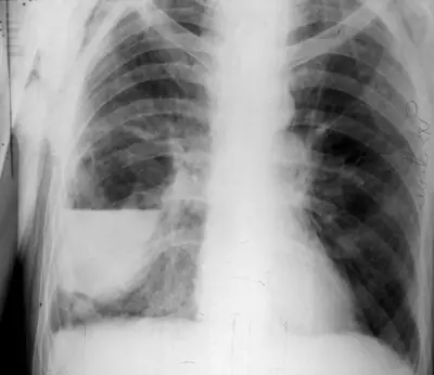 Radiograph from the case bank: Lung abscess