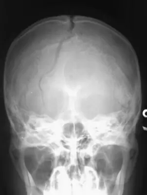 Radiograph from the case bank: Skull fracture
