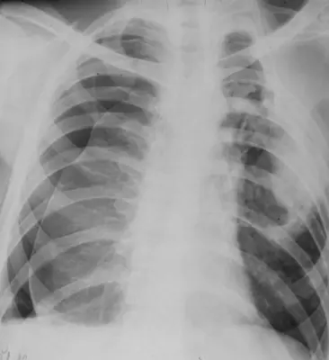 Radiograph from the case bank: Pneumothorax