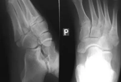 Radiograph from the case bank: Fifth metatarsal fracture (Jones / base)