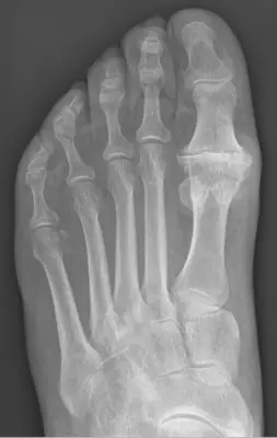 Radiograph from the case bank: Hallux rigidus (first MTP osteoarthritis)