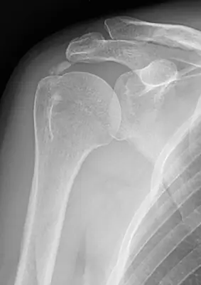 Radiograph from the case bank: Calcific tendinitis