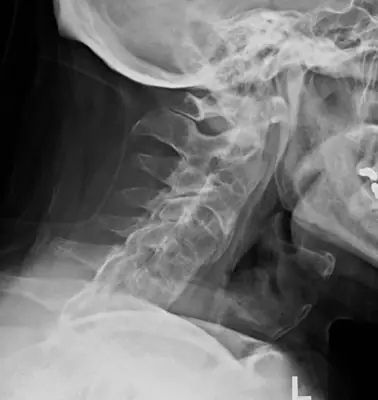 Radiograph from the case bank: Ankylosing spondylitis