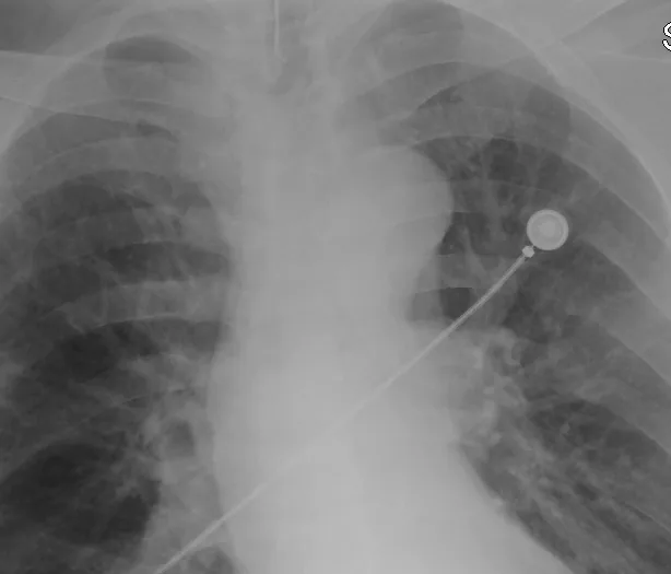 Lines & tubes radiograph for self-assessment