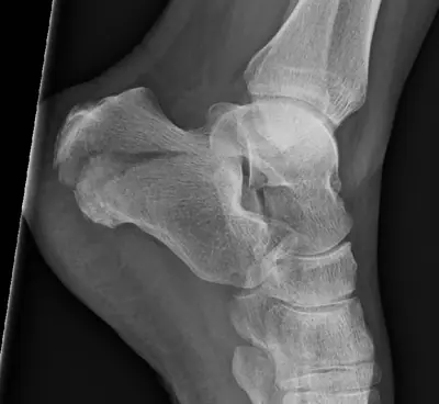 Radiograph from the case bank: Calcaneal fracture