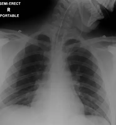 Radiograph from the case bank: Endotracheal tube