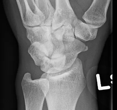 Radiograph from the case bank: Scaphoid fracture