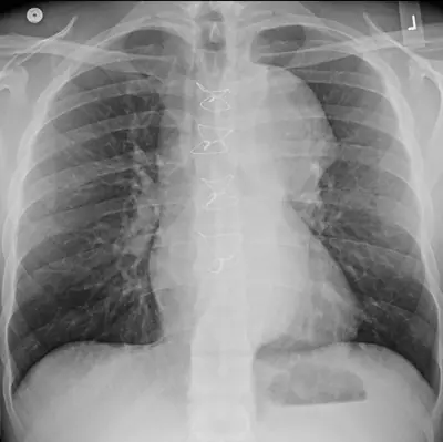 Radiograph from the case bank: Thoracic aortic aneurysm