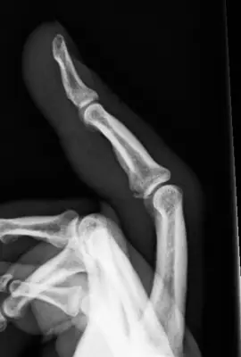 Radiograph from the case bank: Finger (phalangeal) fracture
