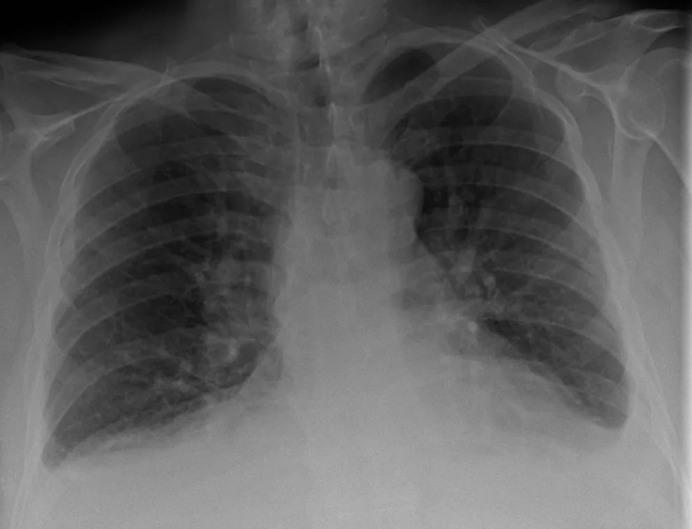 Chest radiograph for self-assessment