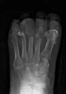 Radiograph from the case bank: Osteomyelitis