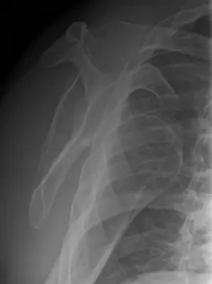 Radiograph from the case bank: Shoulder (glenohumeral) dislocation