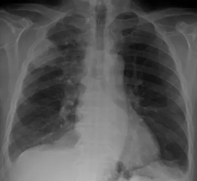 Radiograph from the case bank: Lung cancer (mass)