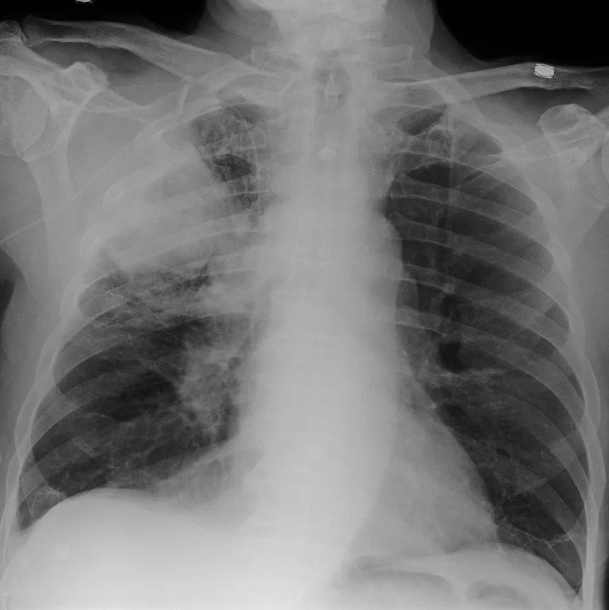Chest radiograph for self-assessment