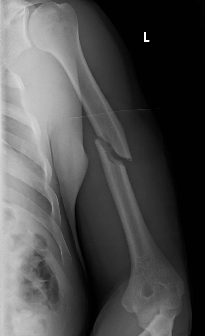 Upper limb radiograph for self-assessment