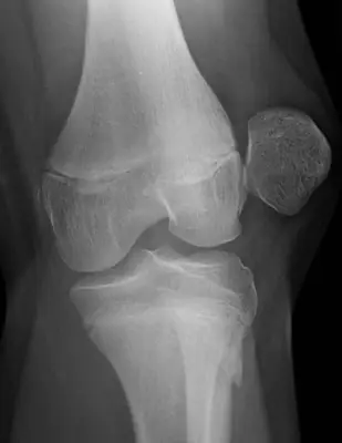 Radiograph from the case bank: Patellar dislocation