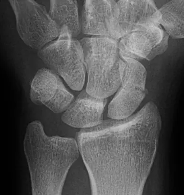 Radiograph from the case bank: Scaphoid fracture