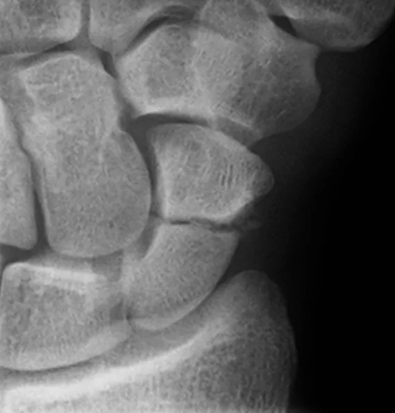 Upper limb radiograph for self-assessment