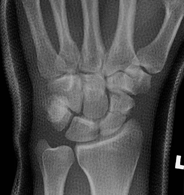 Upper limb radiograph for self-assessment