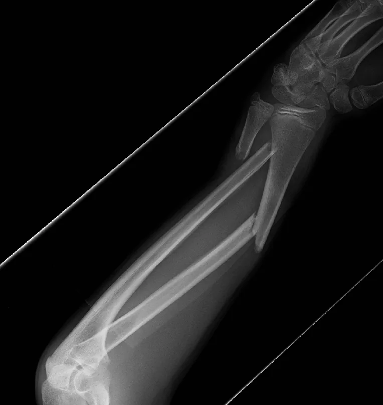 Upper limb radiograph for self-assessment