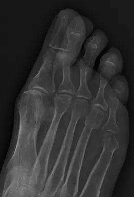 Radiograph from the case bank: Freiberg disease