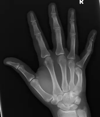 Radiograph from the case bank: Metacarpal fracture