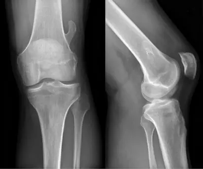 Radiograph from the case bank: Osteochondroma (exostosis)