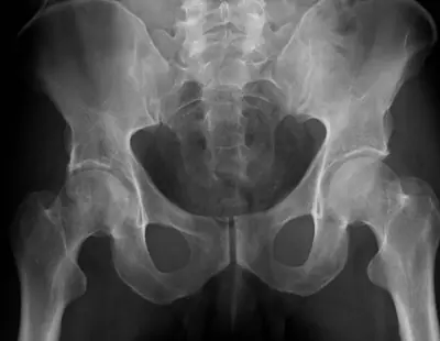 Radiograph from the case bank: Acetabular fracture