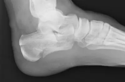 Radiograph from the case bank: Calcaneal fracture