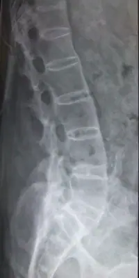 Radiograph from the case bank: Ankylosing spondylitis