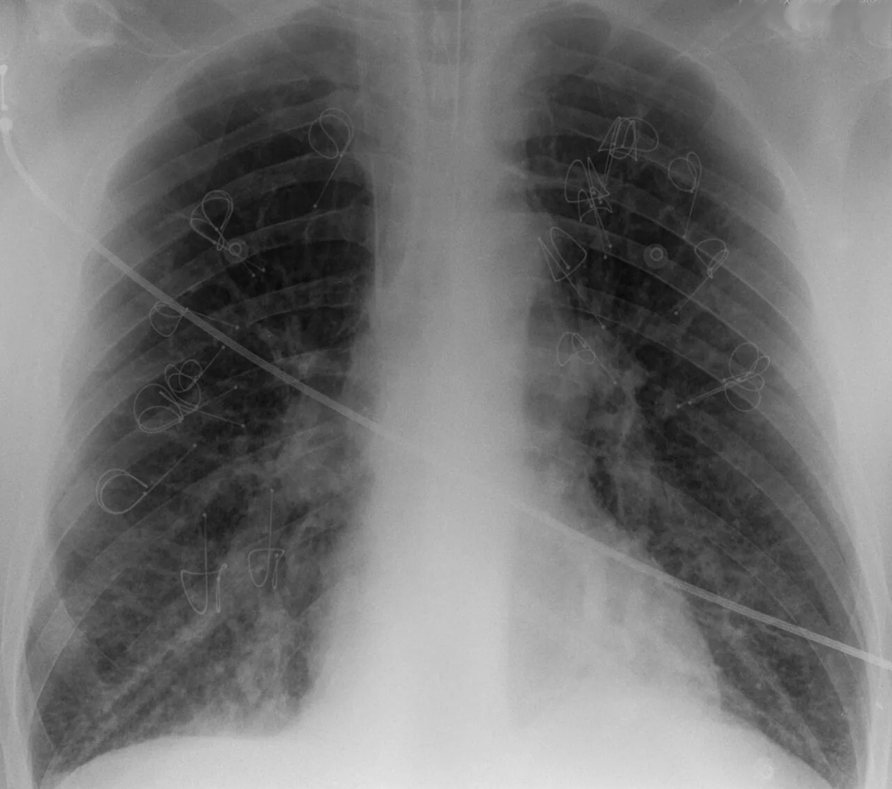 Chest radiograph for self-assessment