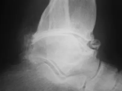Radiograph from the case bank: Osteoarthritis