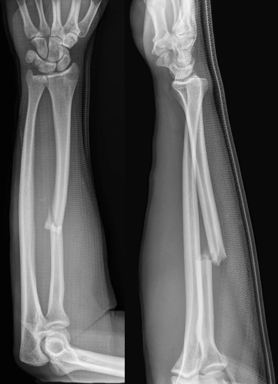 Upper limb radiograph for self-assessment