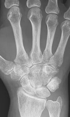 Radiograph from the case bank: Rheumatoid arthritis