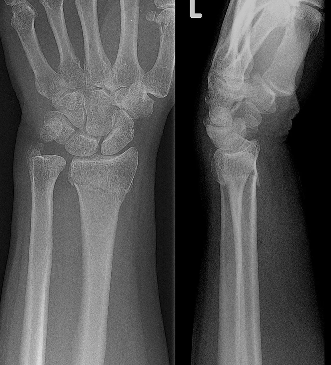 Upper limb radiograph for self-assessment