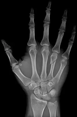 Radiograph from the case bank: Metacarpal fracture