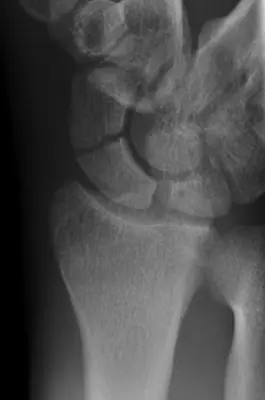 Radiograph from the case bank: Scaphoid fracture