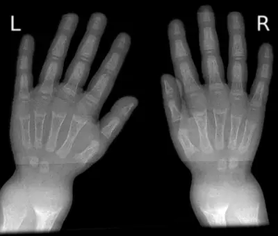 Radiograph from the case bank: Rickets