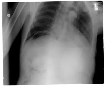 Radiograph from the case bank: Pneumoperitoneum (free intraperitoneal gas)