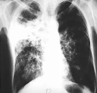 Radiograph from the case bank: Pulmonary tuberculosis