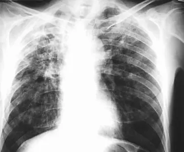 Radiograph from the case bank: Pulmonary tuberculosis