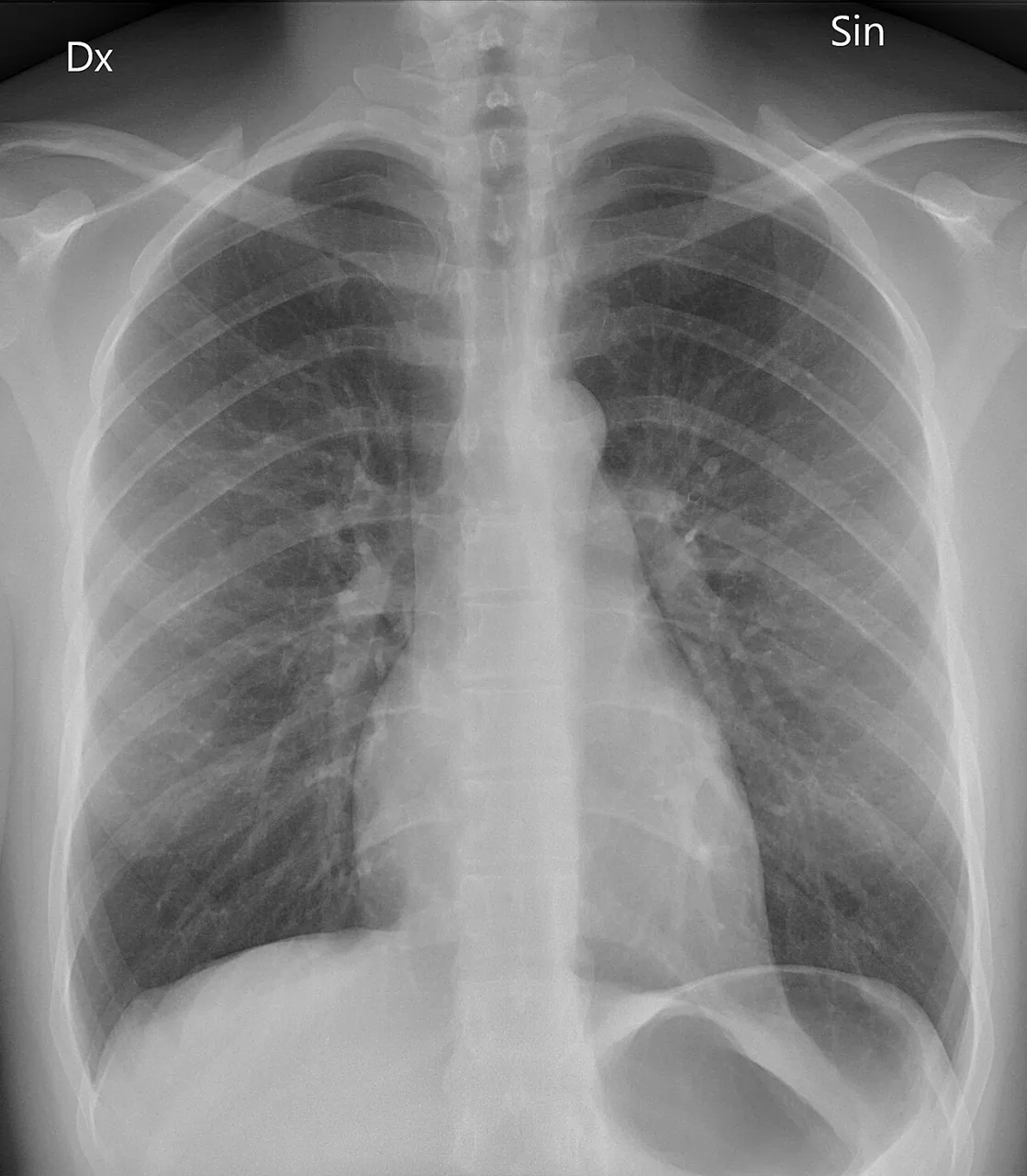 Chest radiograph for self-assessment