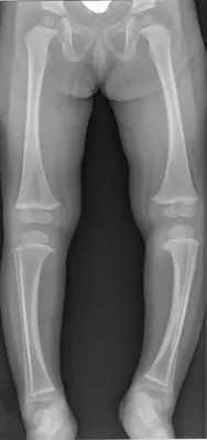 Radiograph from the case bank: Blount disease (tibia vara)